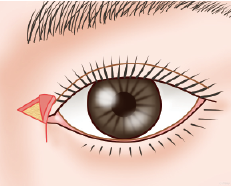 手順02：皮弁を挙上します。